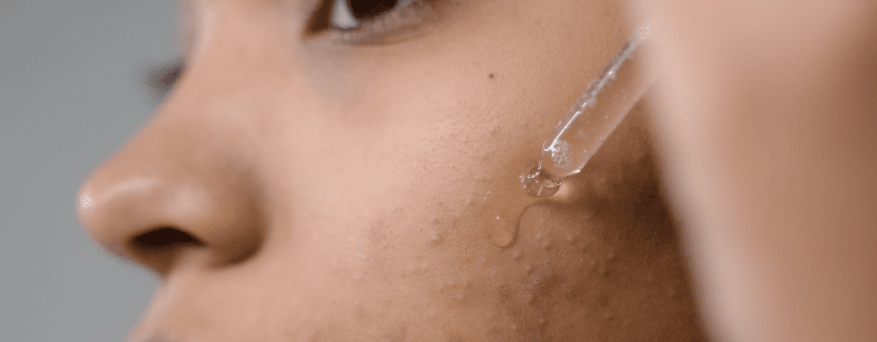 CBD ed acne: un rimedio efficace per una pelle radiosa e senza imperfezioni