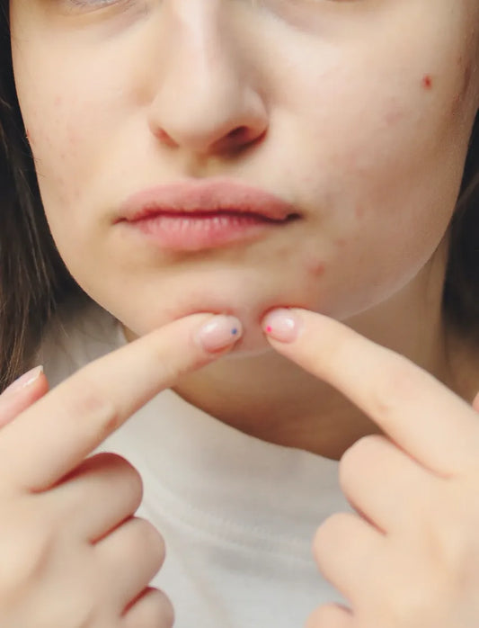 Olio di cbd per contrastare l'acne - Oily Moly